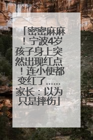 密密麻麻！宁波4岁孩子身上突然出现红点！连小便都变红了……家长：以为只是摔伤